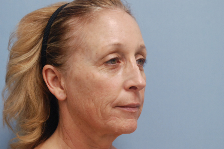 Before Image: Patient # 75149 - front
