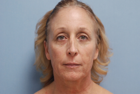 Before Image: Patient # 75149 - front