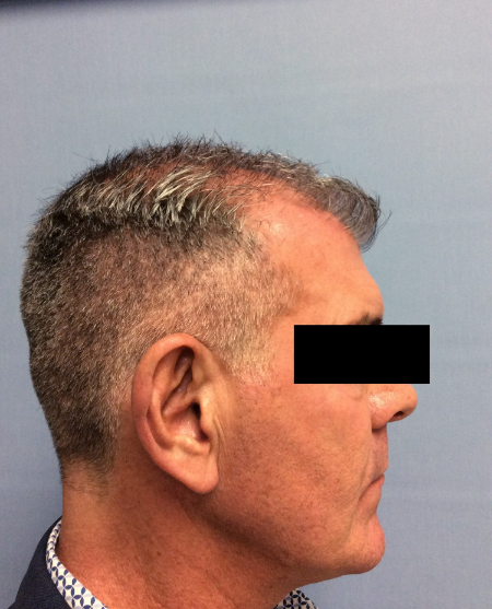 Before Image: Patient # 60657 - front