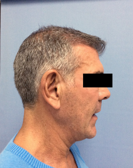 After Image: Patient # 60657 - front