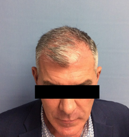 Before Image: Patient # 60657 - front