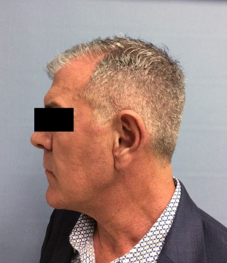 Before Image: Patient # 60657 - front