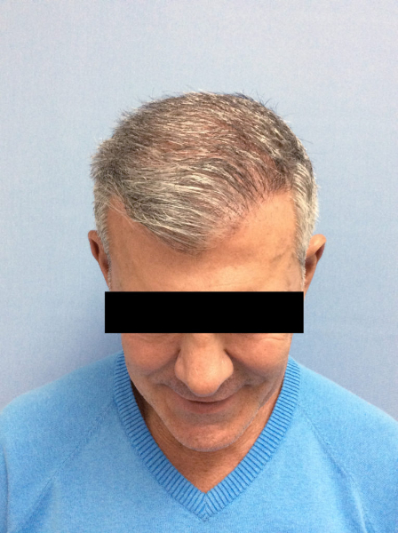 After Image: Patient # 60657 - front