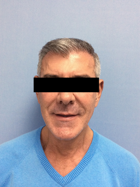 After Image: Patient # 60657 - front