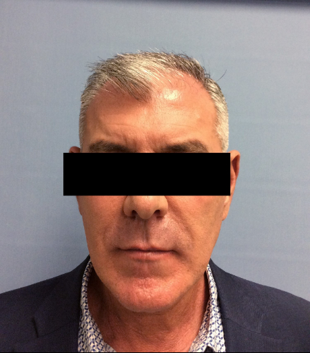 Before Image: Patient # 60657 - front