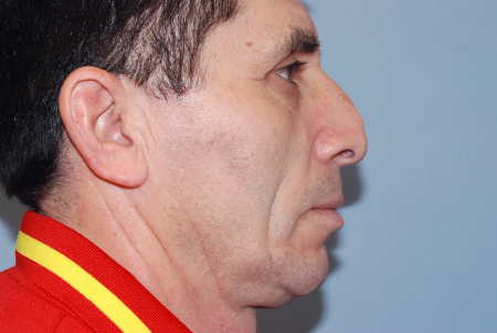 Before Image: Patient # 61403 - front