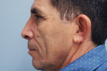 After Image: Patient # 61403 - front