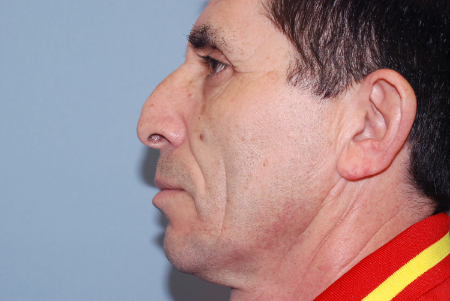 Before Image: Patient # 61403 - front
