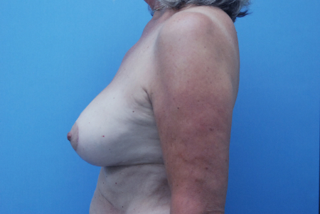 After Image: Patient # 43751 - front