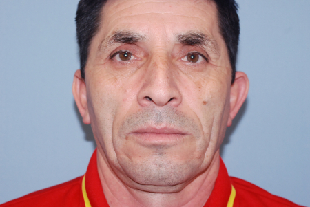 Before Image: Patient # 61403 - front
