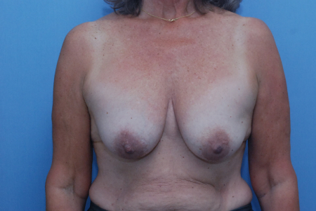 Before Image: Patient # 43751 - front