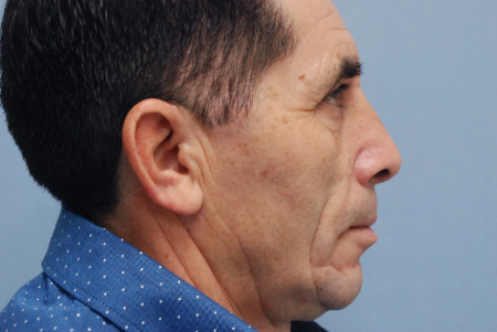 After Image: Patient # 61403 - front