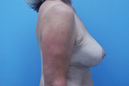 After Image: Patient # 43751 - front