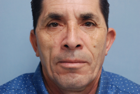 After Image: Patient # 61403 - front