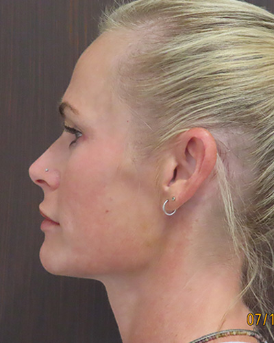After Image: Patient # 60076 - front