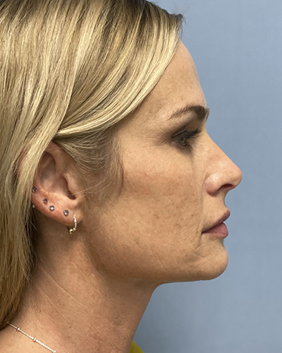 Before Image: Patient # 60076 - front