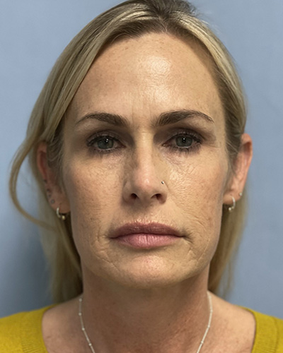 Before Image: Patient # 60076 - front