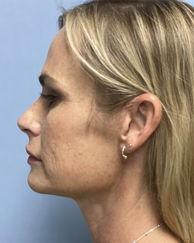 Before Image: Patient # 60076 - front