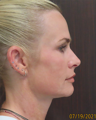 After Image: Patient # 60076 - front