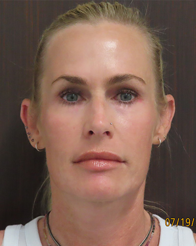 After Image: Patient # 60076 - front