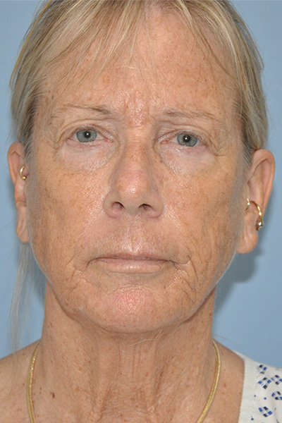 Patient # 66025