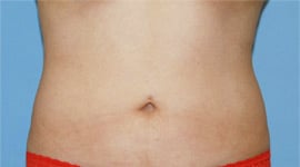 After Image of Liposuction La Jolla