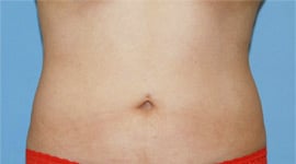 patient’s bare stomach after liposuction, flatter after procedure