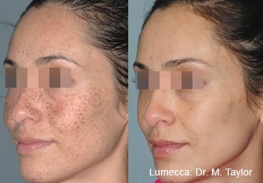Before after face lumecca La Jolla CA