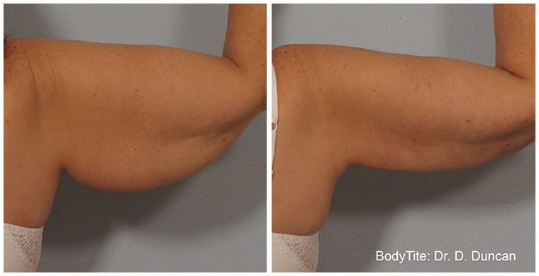 Before & After Image of BodyTite Body Contouring La Jolla