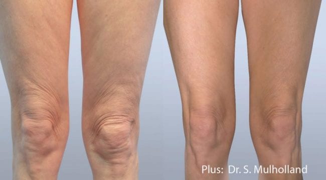 Before & After Image of BodyTite Body Contouring Carlsbad