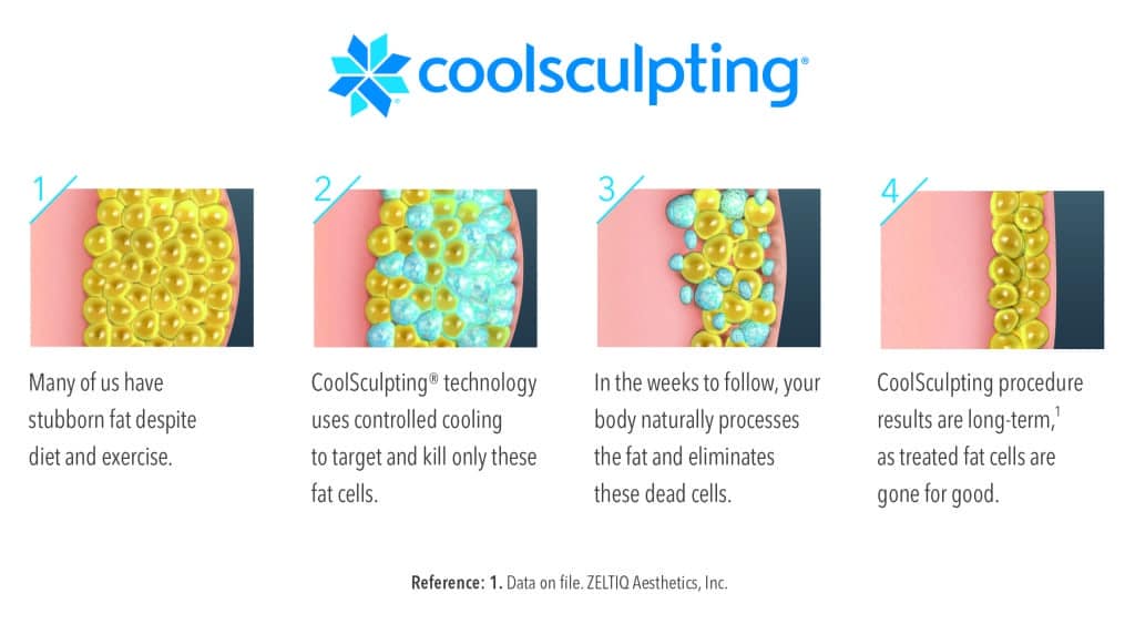 CoolSculpting La Jolla CA