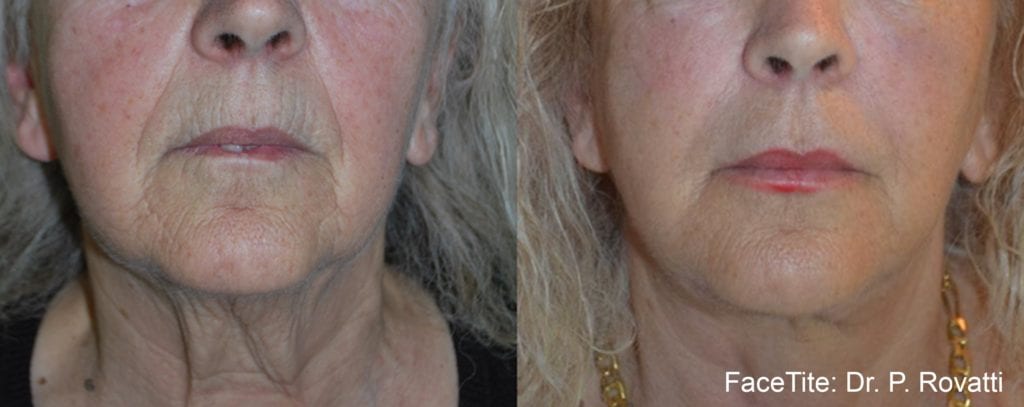 Before & After Image of Facial Skin Tightening Carlsbad