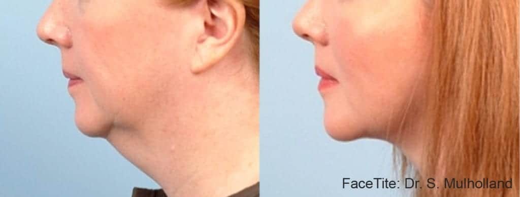 Before & After Image of Facial Skin Tightening La Jolla
