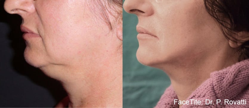 Before & After Image of FaceTite™ La Jolla