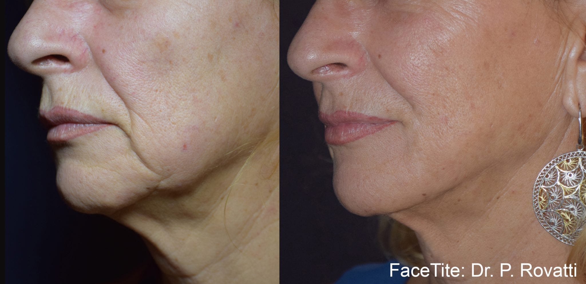 Before & After Image of FaceTite™Carlsbad