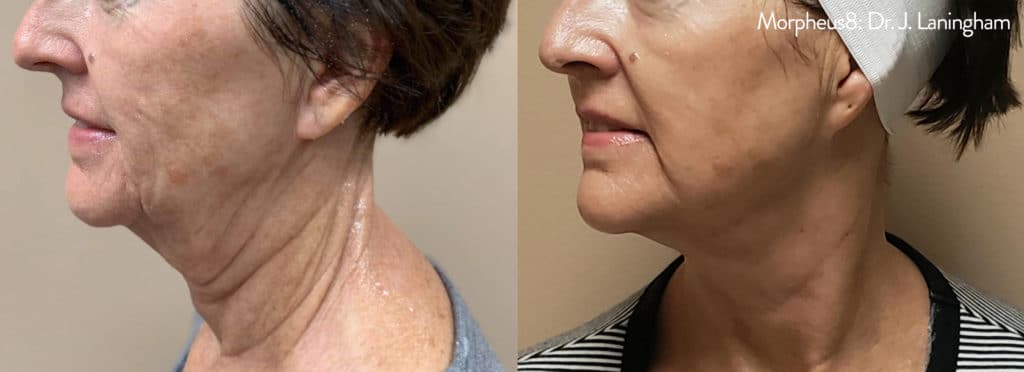 woman’s face and neck before and after Morpheus8 with less wrinkles after treatment