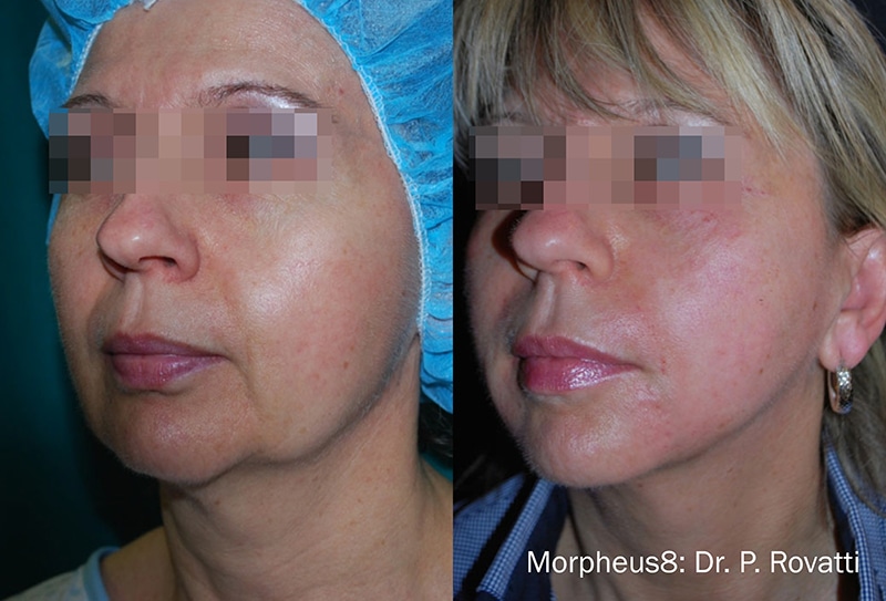 woman’s face before and after Morpheus8 with much tighter cheeks after procedure