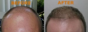 Before & After Image of Hair Transplant La Jolla