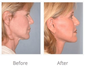 Before and After Image of Facelift La Jolla CA