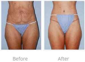 Before and After Image of Buttock Lift La Jolla