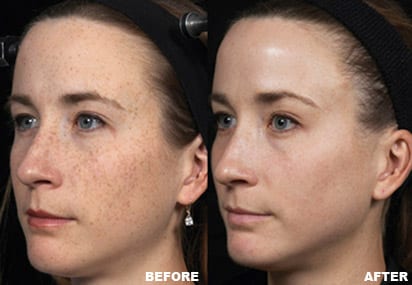 Before & After Image of Fraxel Carlsbad CA