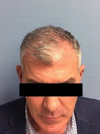 Before image of Hair Restoration Carlsbad
