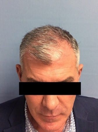 Hair Transplant