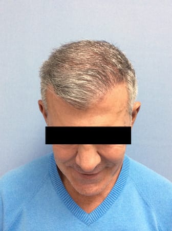 After image of Hair Restoration Carlsbad