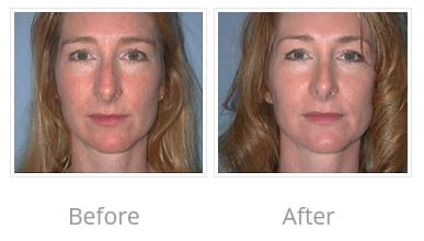 Before & After Image of Rhinoplasty La Jolla CA