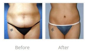 Before & After Image of Tummy Tuck La Jolla