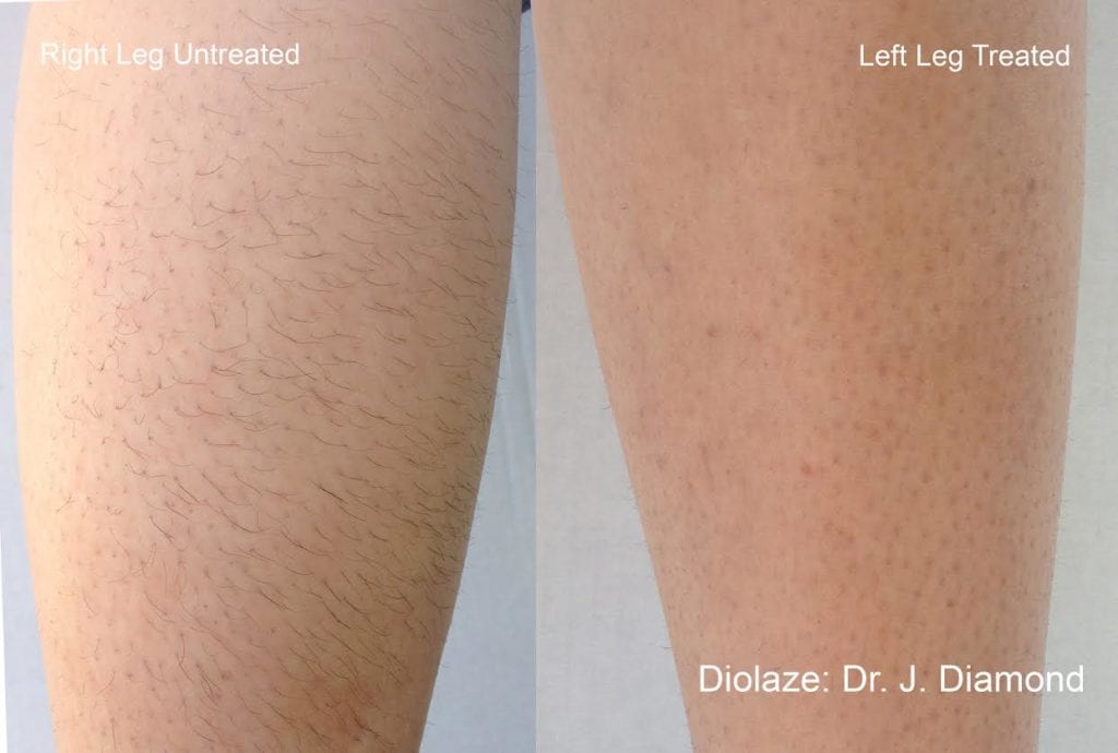 Laser Hair Removal La Jolla CA