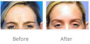 female patient’s forehead before and after botox injections, frown lines gone after treatment