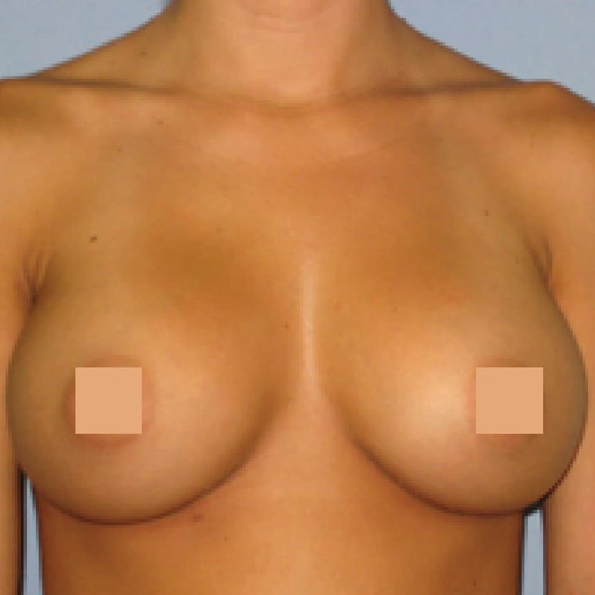 breast afteredited@2x