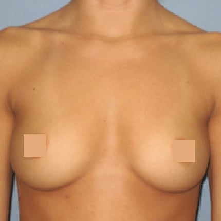 breast beforeedited